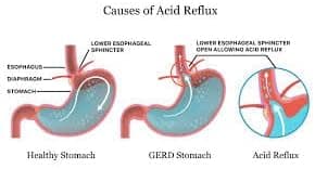 Melox for Heartburn Relief