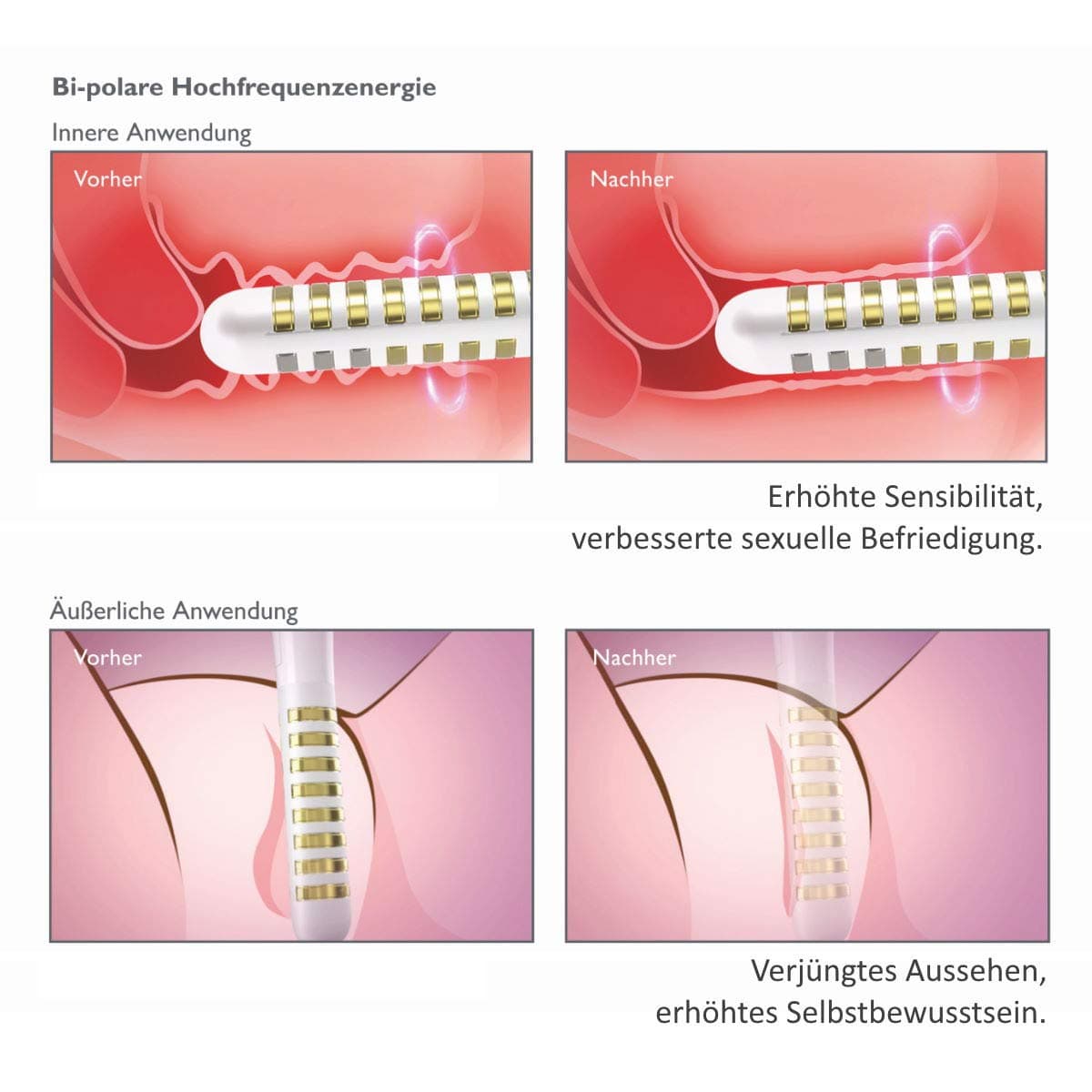 Silk'n Tightra, White