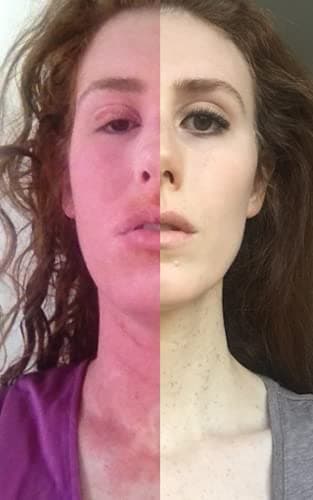 Curing my Incurable Eczema